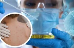 Lija e majmunit i afrohet Shqipërisë, konfirmohet rasti i parë në Greqi