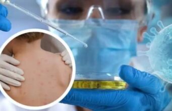 Lija e majmunit i afrohet Shqipërisë, konfirmohet rasti i parë në Greqi